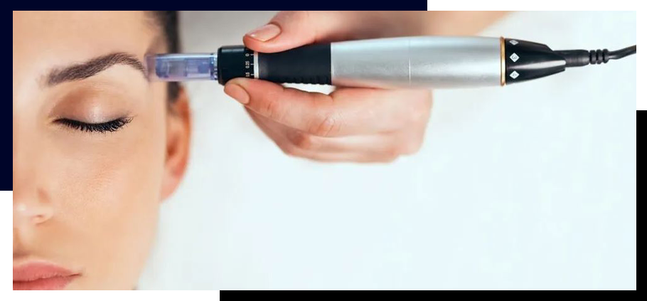 Microneedling